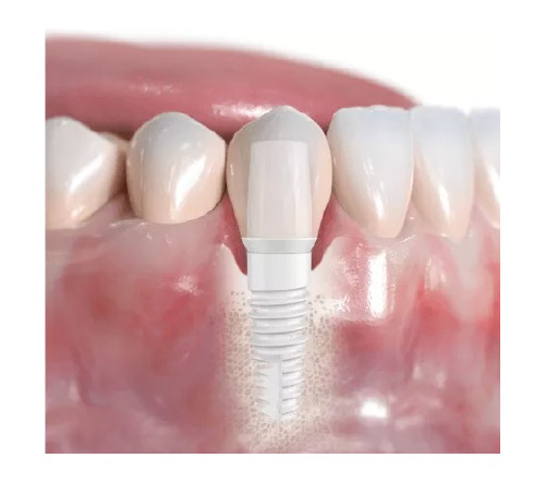 Ceramic zirconia dental implant positioned among natural teeth, showcasing a metal-free, aesthetic alternative for restorative dentistry.