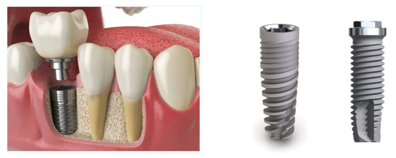 Illustration of endosteal dental implants placed in the jawbone, showcasing the osseointegration process with titanium implants and surrounding natural teeth.
