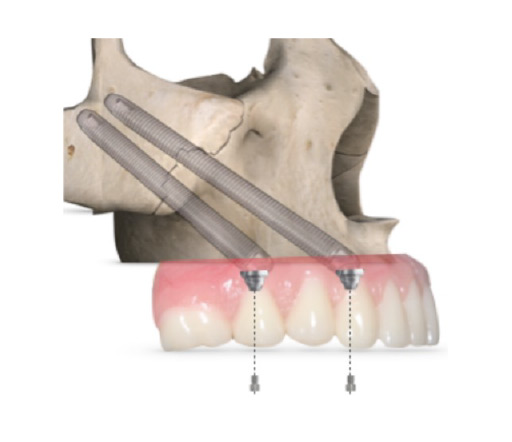 Zygomatic implants illustrated with placement in the zygomatic bone, showcasing dental restoration with a prosthetic bridge.