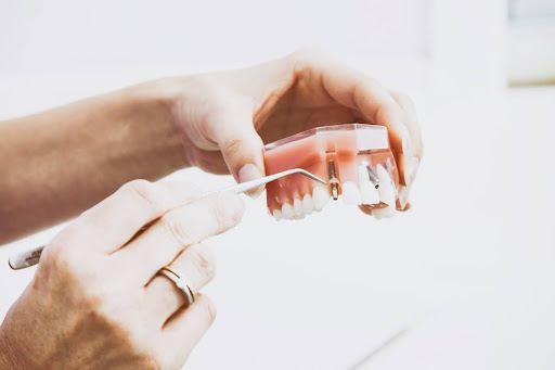 unnamed (1) dental implants