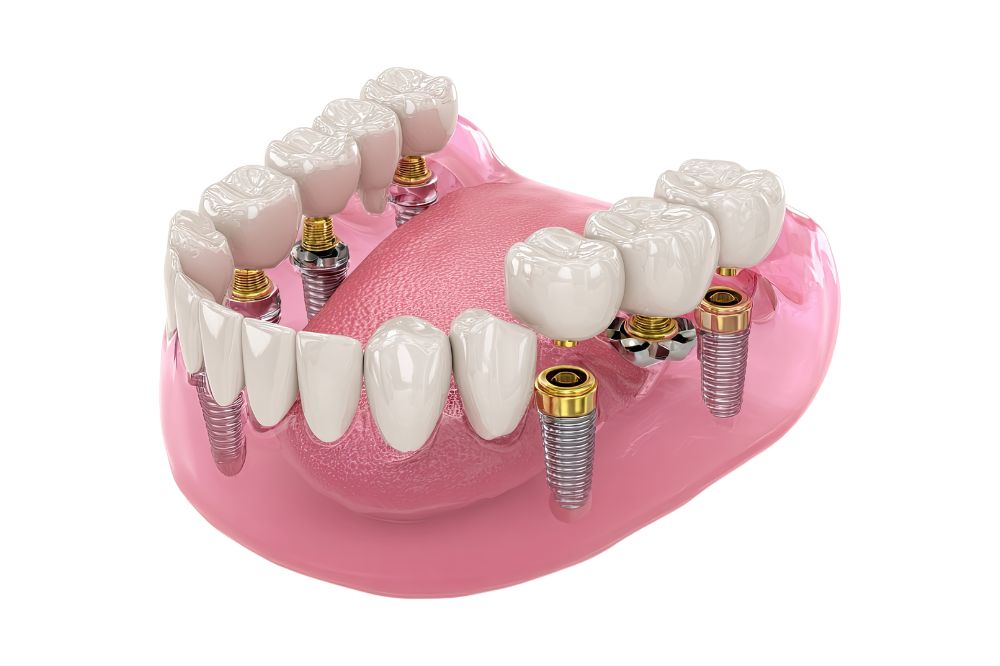 How Full-Arch Restoration Can Give You a New Smile in Just One Day